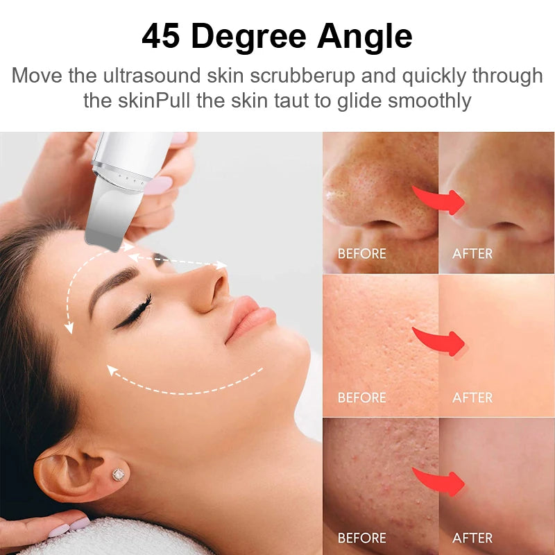 Espatula Peeling Ultrassonica Limpeza Facial Removedor Cravos